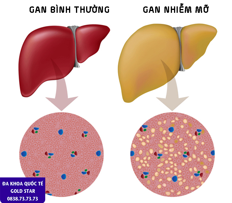 Anh benh ly Gan nhiem mo