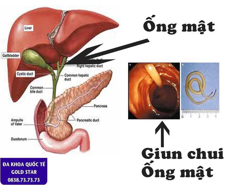 Benh ly Giun chui ong mat