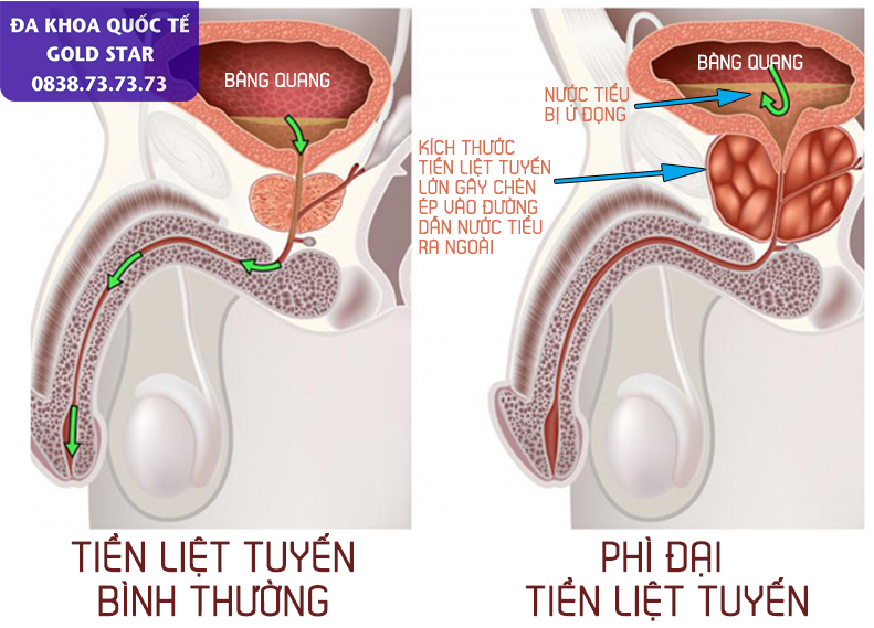 Phi dai tien liet tuyen