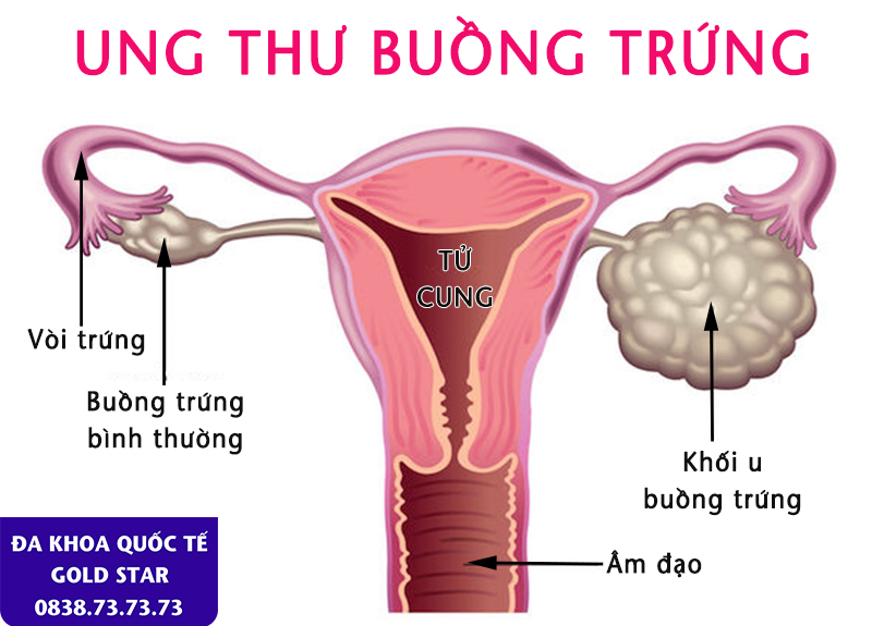 hinh anh benh ly ung thu buong trung