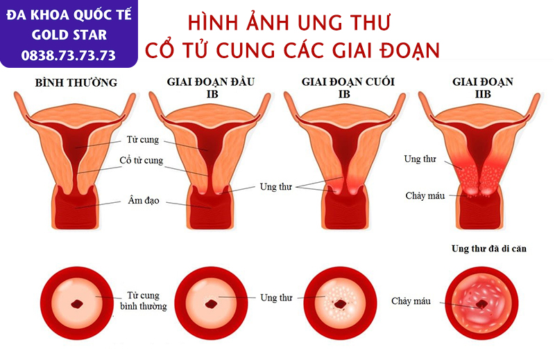 hinh anh ton thuong ung thu co tu cung cac giai doan