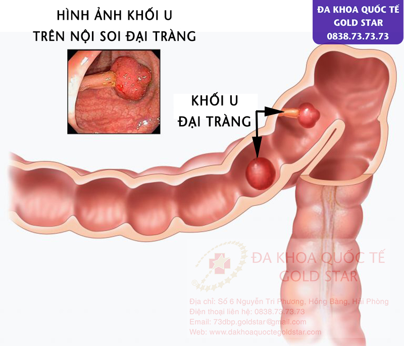 hinh anh ung thu dai truc trang