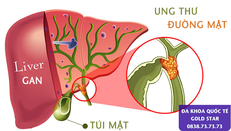 Hinh anh benh ly ung thu duong mat