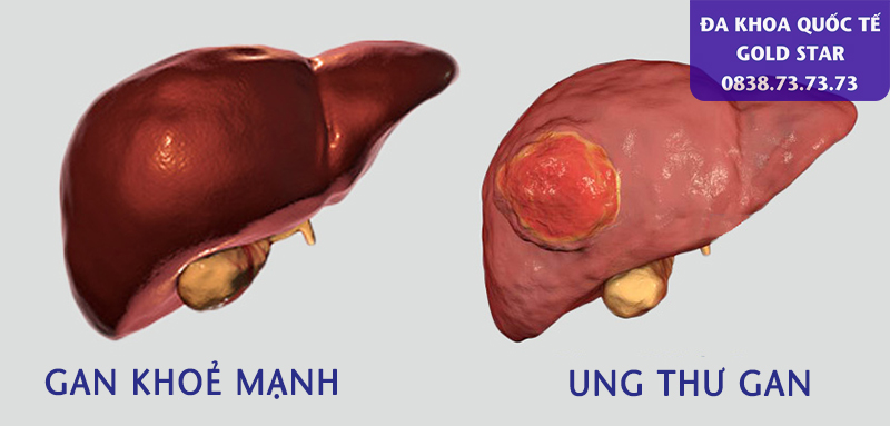 Hình ảnh bệnh lý ung thư gan