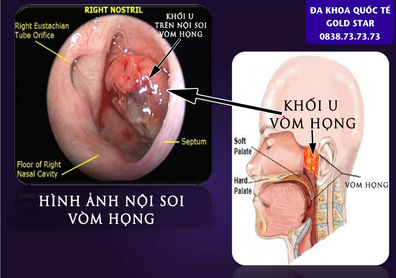 Hinh anh giai phau vung vom hong va khoi u vung vom hong tren noi soi